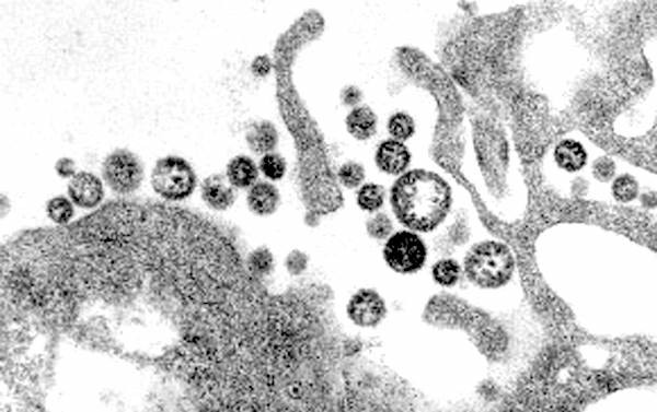 Lassa Fever Emory patient confirmed at University Hospital to undergo treatment for deadly virus