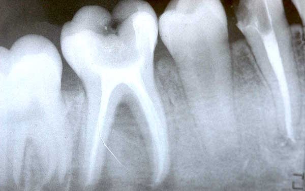 Gum disease, Alzheimer's link in new study revealed