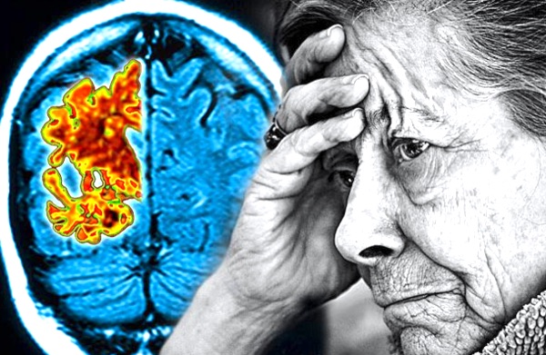 Marijuana for Alzheimer's Treatment